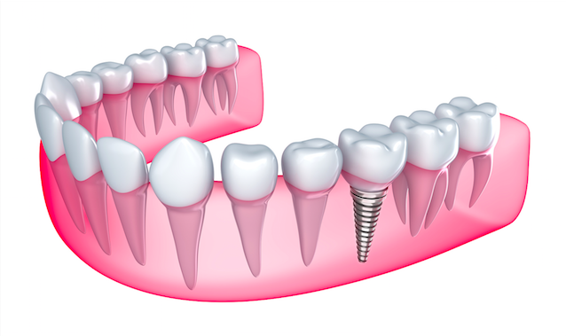 Dental Implants Lancaster PA