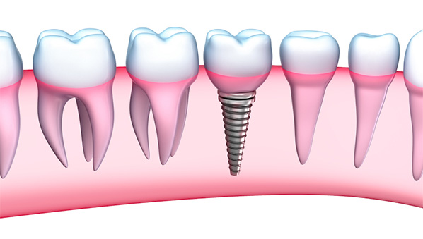 Dental implants Lancaster pa