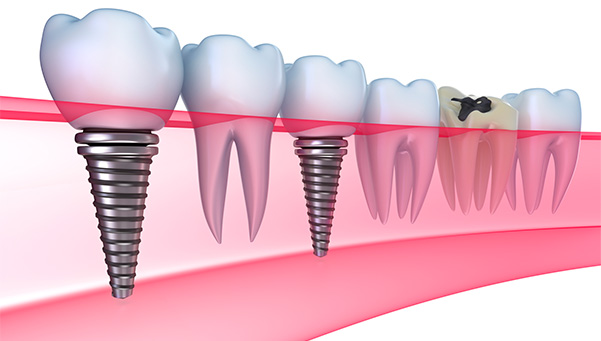 Lancaster pa dental implants